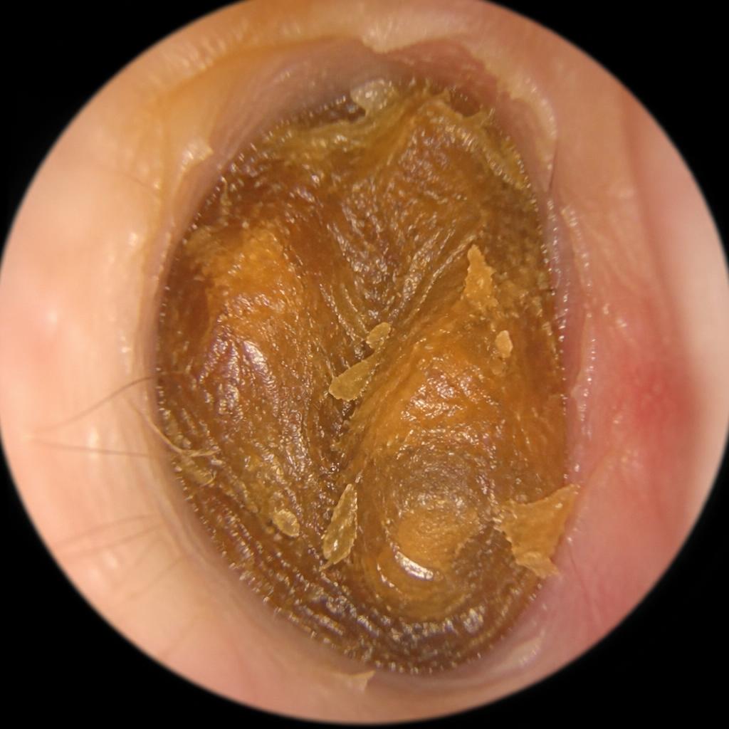 An ear canal fully blocked with built-up wax before treatment